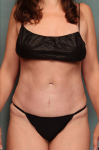 Tummy Tuck Case 15 After
